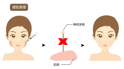 1肉毒素瘦脸,一次可保两年?