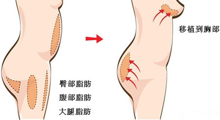 即可踌琶劳 整形中心 胸部整形 自体脂肪隆胸 > 正文 首先选择抽取