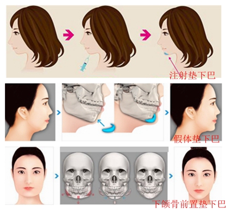 但维持期基本只有半年;截骨前置垫下巴适合下颌骨后缩的人,维持时间较