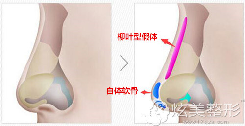 柳叶型假体和l型假体哪个隆鼻效果更好