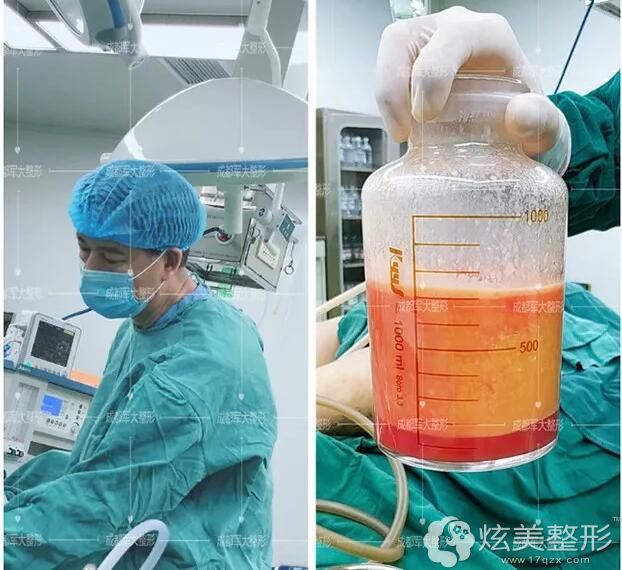 大腿吸脂过程中抽出来的脂肪