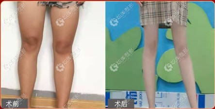 杨本明医生做超5g钻石射频溶脂瘦大腿的图片来了