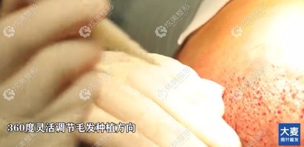 深圳大麦植发采用微针植发技术