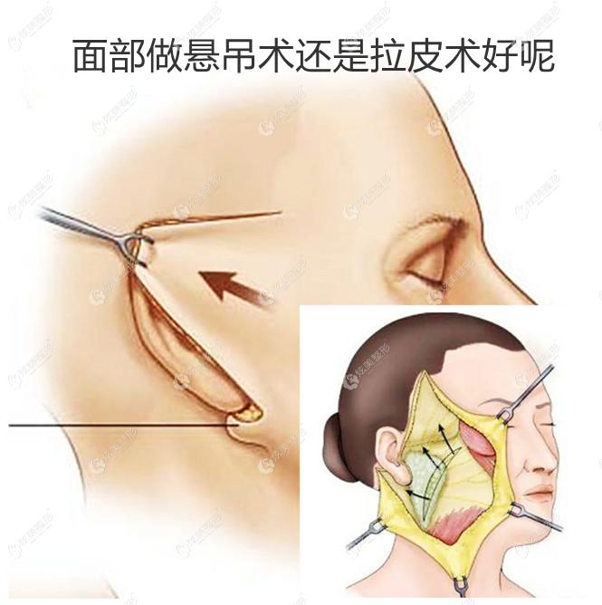 面部做悬吊术好还是拉皮术好据说悬吊比拉皮提升恢复更快哦