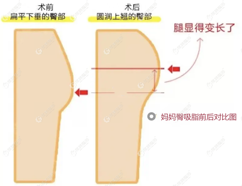 妈妈臀抽脂是指什么部位从吸脂前后对比图来看臀线提高了