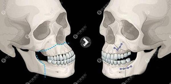 分享双鄂手术图解关心双鄂手术能否改善面中部脸长的来详细了解整形案例 上海愉悦薇莱医疗美容医院 炫美网