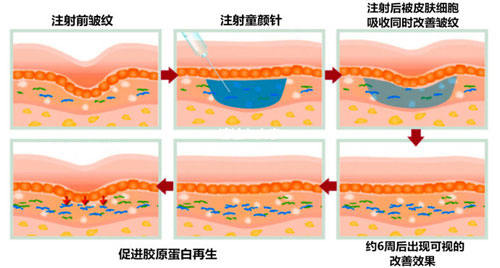 童顏針作用效果