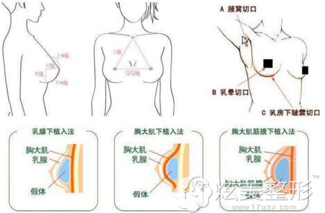 假体隆胸方法示意图