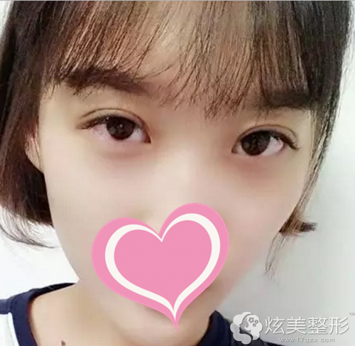 姓名:小郭美麗煩惱:單眼皮,上瞼下垂蛻變方案:切開雙眼皮手術醫生