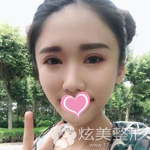 自從在南寧達美做完眼綜合後終於體驗到大眼女神的魅力