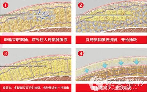 抽脂腰部手术大概花多少钱_腰部抽脂风险大吗_腰部抽脂多少钱