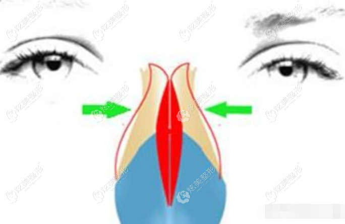 鼻骨内推千万别做 辟谣后 鼻背宽的 伪塌鼻梁 还是要做 注意事项 炫美网