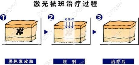 林医生做皮秒激光祛斑的原理