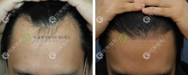 韩国布莱克毛发移植中心做毛发移植效果图