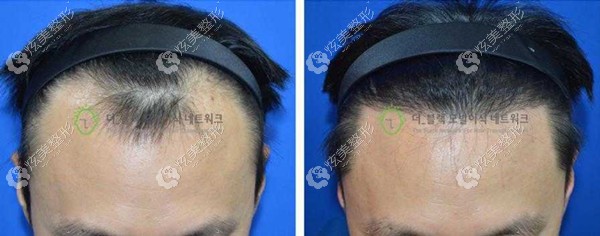 韩国布莱克毛发移植中心做男士发际线移植效果图