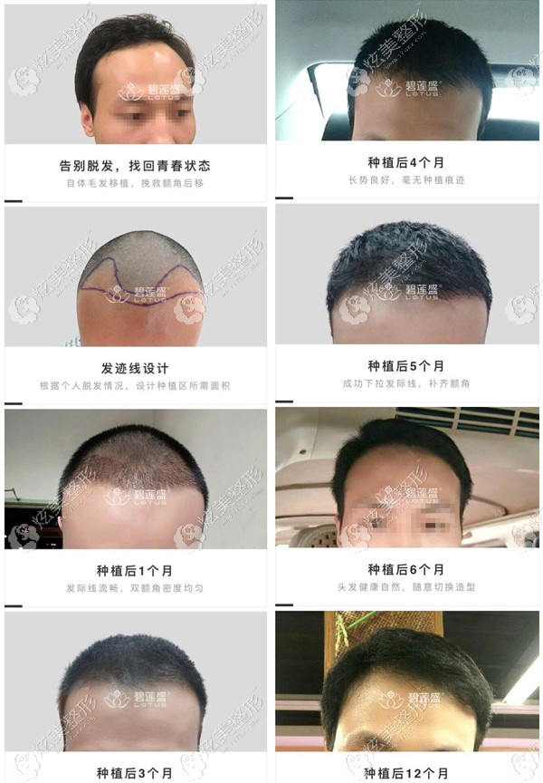 一张发际线种植图片来看北京碧莲盛sht无痕植发技术好不好