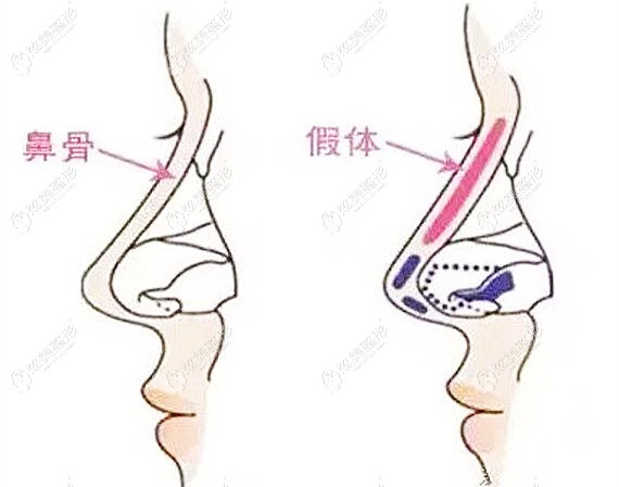 查詢過青島博士做假體隆鼻價格後還想看楊永勝醫生做鼻子的圖片