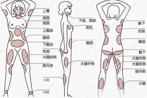 大腿環吸手術包括哪些部位的圖解