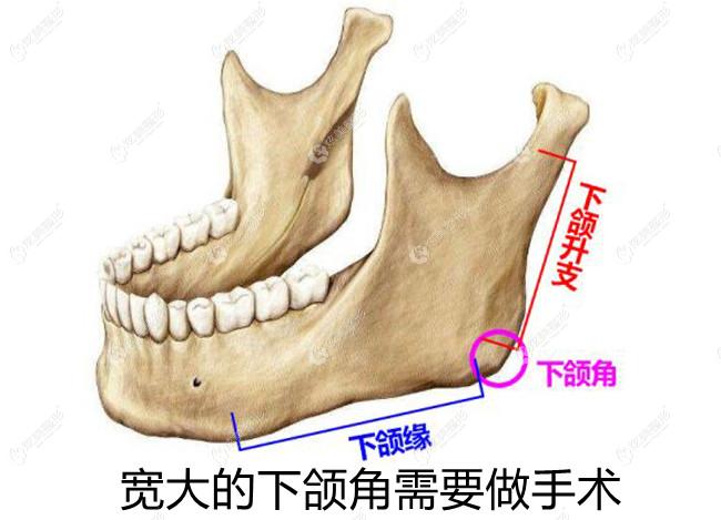 下颌角磨骨和削骨手术哪个好呢?据了解两个手术一起做会更自然