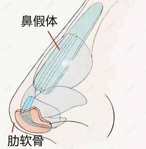 柳州華美做鼻綜合的價格看:半肋骨隆鼻比超肋鼻沒貴