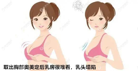 奧美定隆胸15年取出親身經歷乳房凹陷難看輪廓變硬都是有的