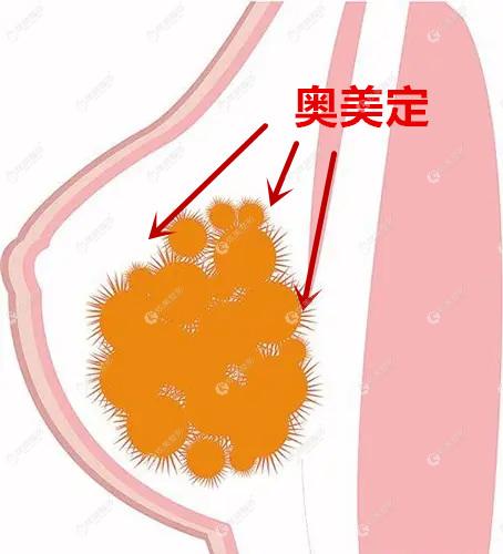 奧美定隆胸15年取出親身經歷乳房凹陷難看輪廓變硬都是有的