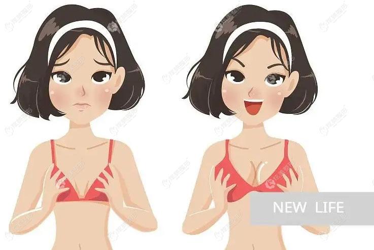 找鵬愛李罡做蓓拉假體深v乳溝隆胸前後對比照