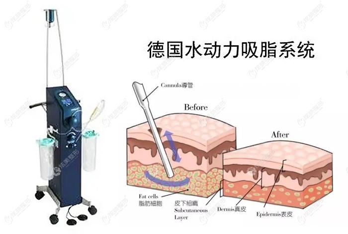 长沙脸博士做水动力吸脂技术