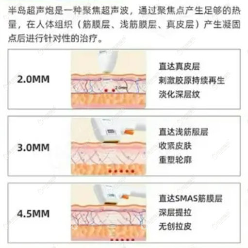 半岛超声炮做全脸一次价格表一览 做300发 500发 1000发的费用不同整形案例 毕节利美康医疗美容门诊部 炫美网