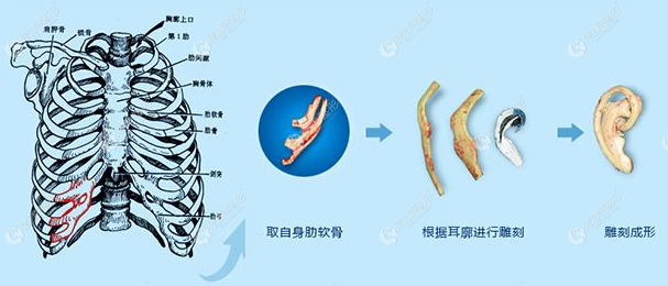 鄭州直埋法再造術價格m.17qzx.com